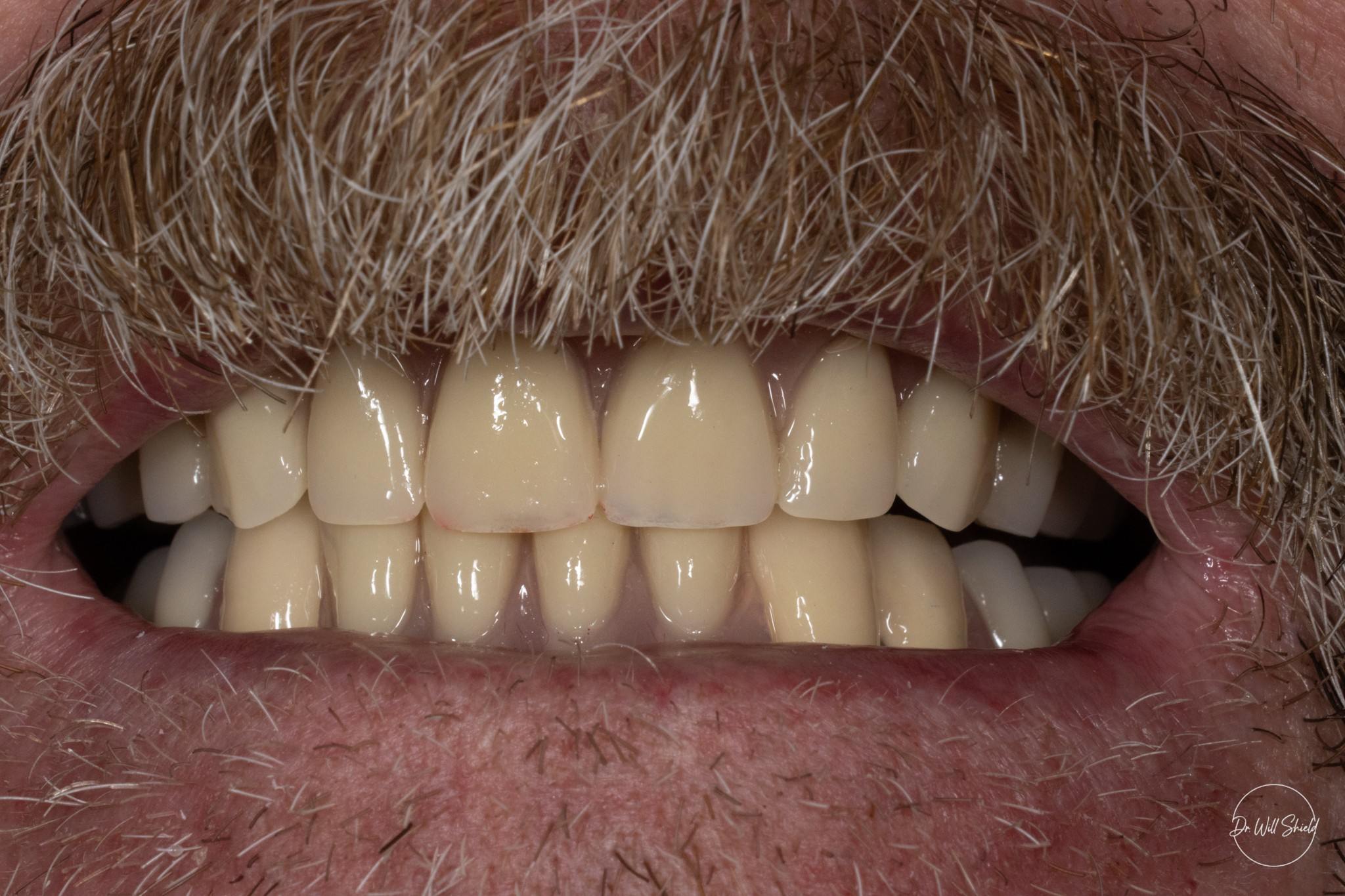 8 crowns With denture 300kb